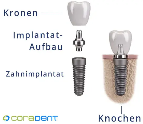 Teile und Struktur eines Zahnimplantats
