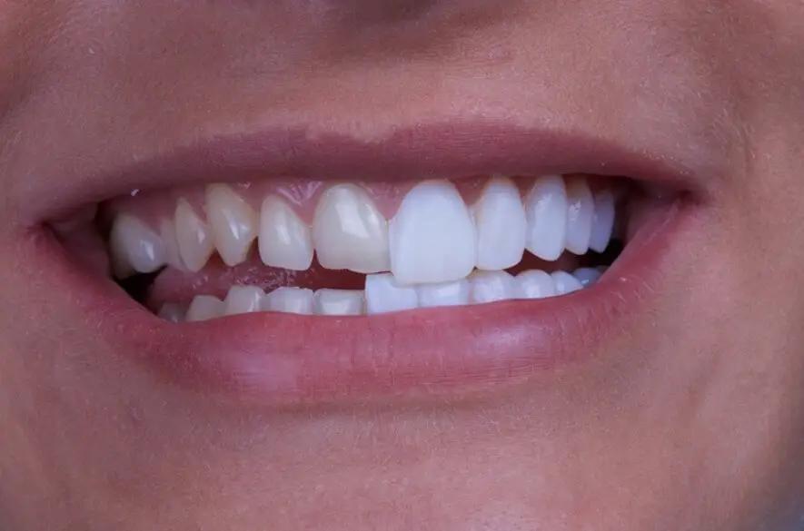 Wirkung von Porzellanschalen (Veneers)