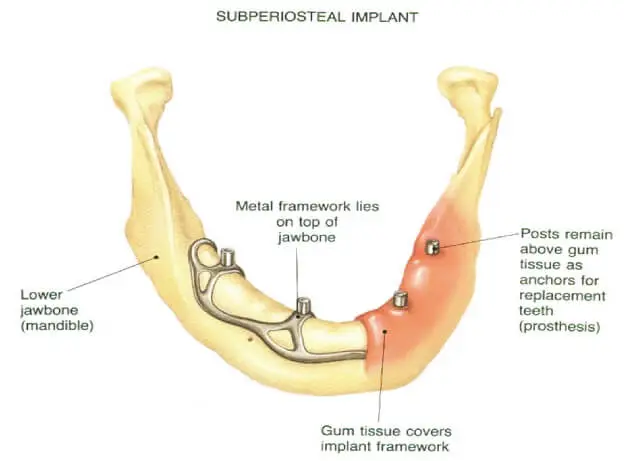 Die Methode zur Platzierung subperiostaler Implantate ist in Abb. dargestellt