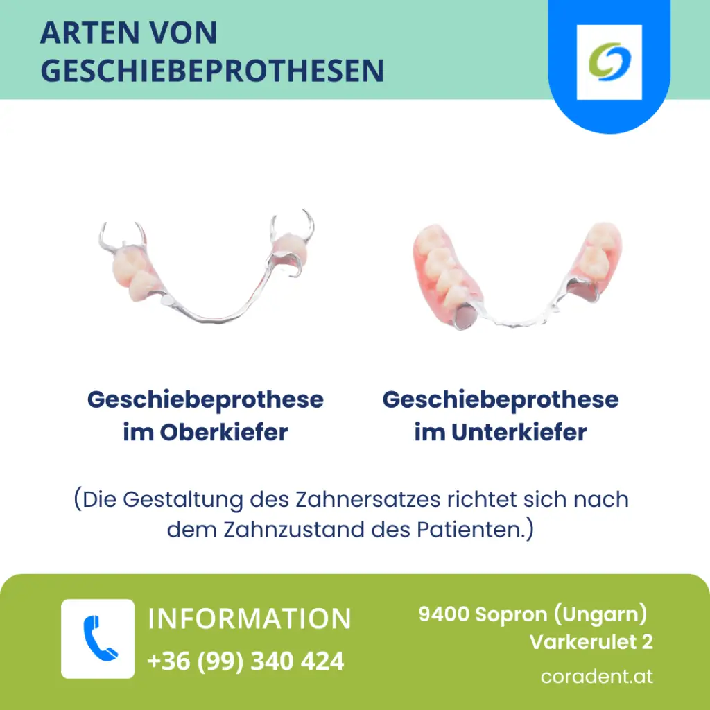 Entdecken Sie die verschiedenen Arten von Geschiebeprothesen, ihre Vorteile und Einsatzmöglichkeiten für optimalen Zahnersatz.