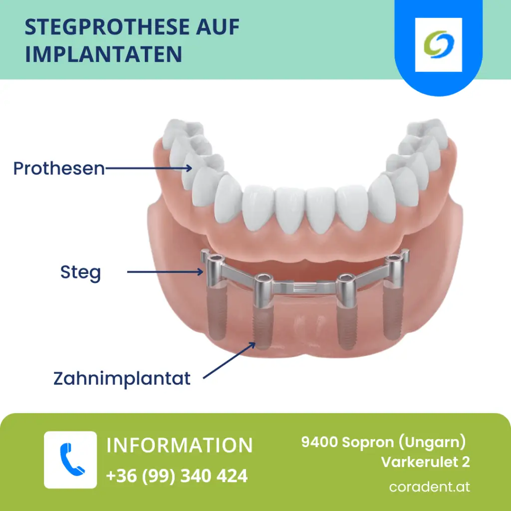 Stegprothesen auf Implantaten bieten festen Halt und hohen Komfort. Informieren Sie sich über Vorteile und individuelle Anpassungen!