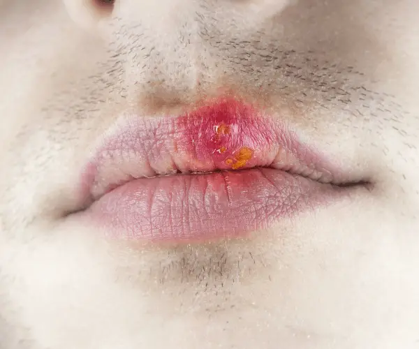 Lippenherpes verstehen: Tipps zur Vorbeugung, Behandlung und Linderung der Symptome für ein gesundes Lächeln.