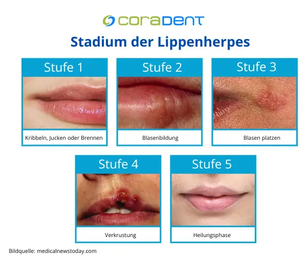 Lippenherpes-Stadien im Detail: Erkennen Sie die Symptome und erfahren Sie, wie Sie die Heilung unterstützen können.
