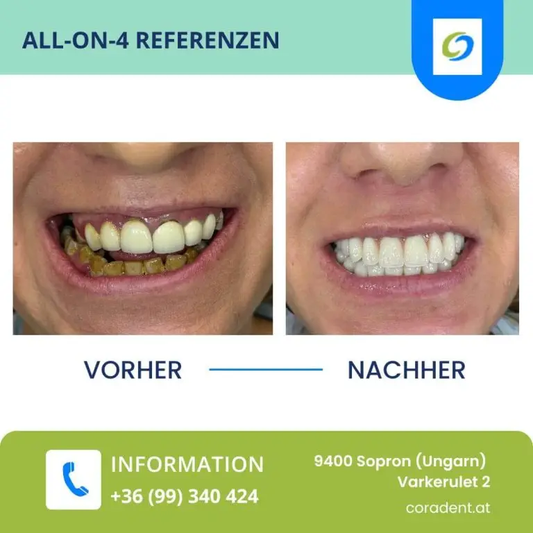 Schauen Sie sich die Vorher- und Nachher-Bilder unserer All-on-4-Referenz an!
