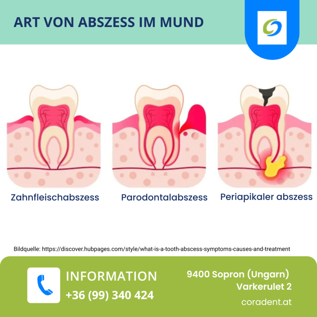 Arten von Abszess im Mund: Parodontal, periapikal, perikoronal & gingival – Ursachen, Symptome und Behandlung im Überblick.