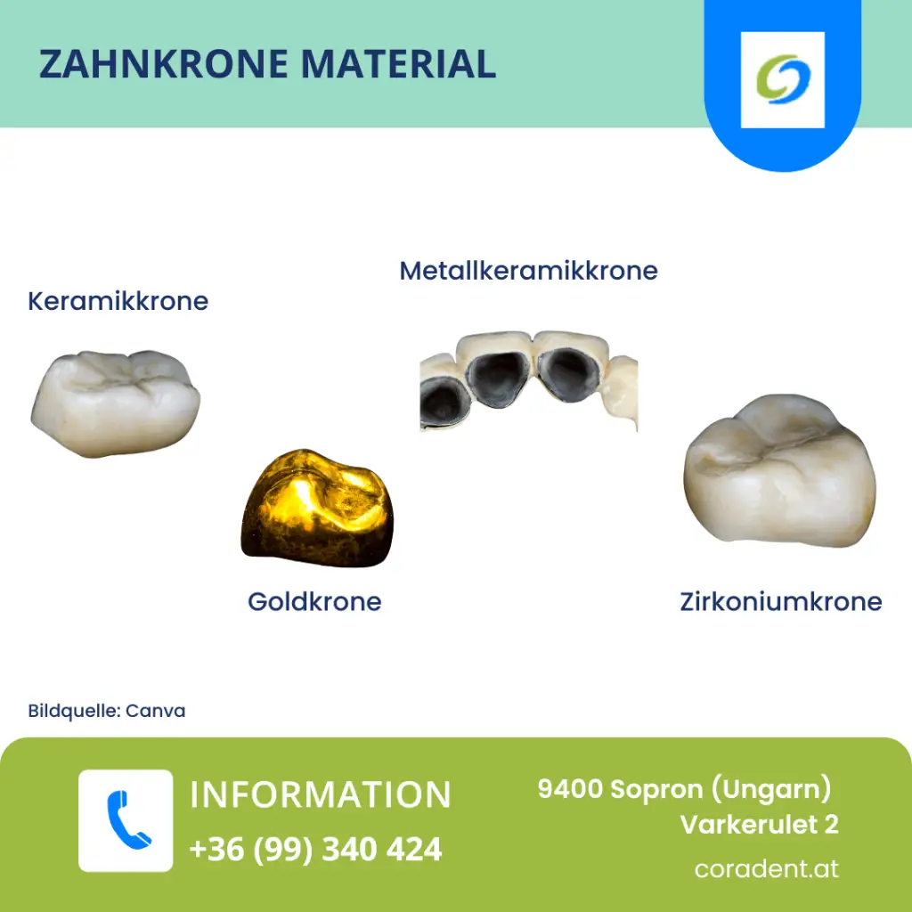Erfahren Sie alles über Materialien für Zahnkronen: Metall, Keramik, Komposite und Zirkoniumoxid für optimale Ästhetik und Haltbarkeit.