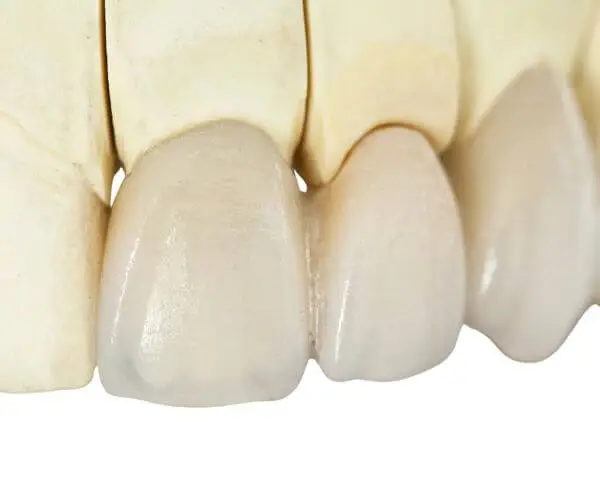 Zirkonkronen haben eine natürliche Transluzenz, die ihnen ein sehr ähnliches Aussehen wie natürliche Zähne verleiht.