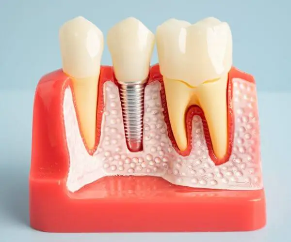 Implantat-Schmerzen effektiv reduzieren: Hausmittel, Medikamente und Nachsorge-Tipps.
