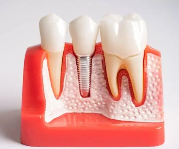 Periimplantitis: Ursachen, Symptome und moderne Behandlungsmethoden für dauerhaften Implantat­erhalt.