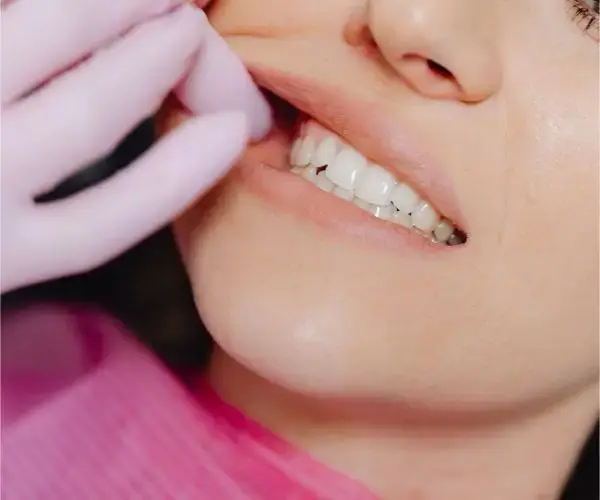 Bild einer Fistel im Mund mit sichtbarer Eiter Öffnung am Zahnfleisch