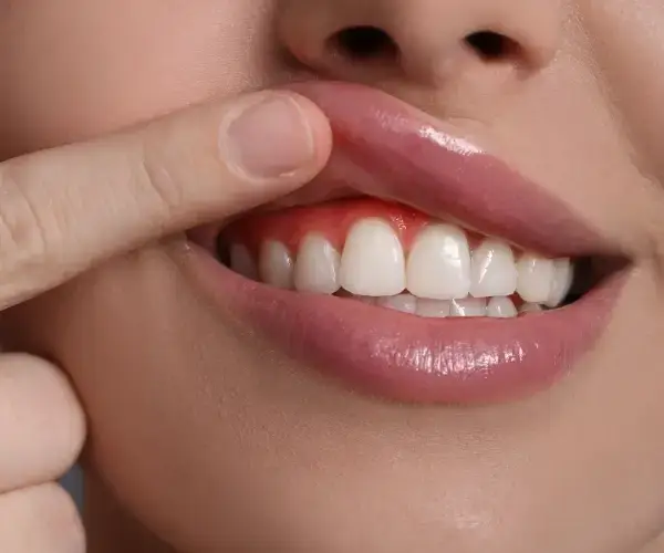 Nahaufnahme eines freiliegenden Zahnhalses mit sichtbar zurückgegangenem Zahnfleisch